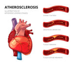 Atherosclerosis. Fibrous plaque formation.